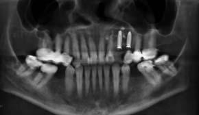 Badania _ Innowacyjne terapie Ryc. 6_Projekcja CBCT po 5 miesiàcach od zabiegu. Ryc. 7a c_stan po 5 miesiàcach od zabiegu, wczesne planowanie usytuo-wania implantów z bowych w miejscu 23, 24. Ryc. 6 Ryc.