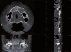 Badanie CBCT umożliwia ocenę inkorporacji i przebudowy przeszczepu na każdym etapie leczenia oraz dokładne zaplanowanie leczenia implantologicznego, które ma fundamentalne znaczenie w kompleksowej