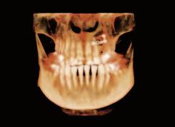 Wojtowicz A, Chaberek S, Urbanowska E, Ostrowski K: Comparison of Efficiency of Platelet Rich Plasma, Hematopoeic Stem Cells and Bone Marrow in Augmentation of mandibular Bone Defects; New York State
