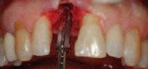 5_Przeprowadzono preparację łoża dla implantu, stosując sekwencję wierteł o