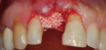 9_Ubytek kostny wypełniono materiałem Endobon Xenograft Granules i pozostawiono do