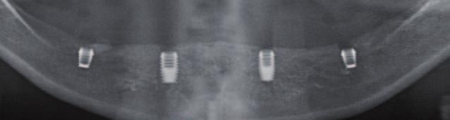 Opis przypadku _ Implanty krótkie Stałe uzupełnienie protetyczne pełnego łuku zębowego, bez metalu, na czterech krótkich implantach Fixed full arch metal-free prosthesis on four short Autor _ Mauro