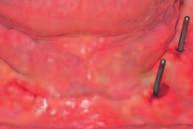 : szerokie lamele tworzące formułę plateau, pochyły kołnierz i studnia implantu utrzymująca łącznik za pomocą systemu locking taper (bezśrubowe, samohamowne połączenie stożkowe cechujące się