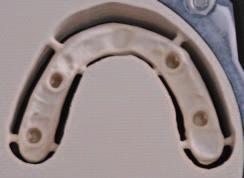 W ten sposób utlenione warstwy powstają zarówno na trzpieniu łącznika, jak i powierzchni studni implantu.