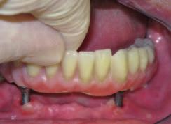 Poddziąsłowa półsferyczna geometria łącznika jest idealna dla tkanki łącznej w okolicy implantu. Łączniki mocowane są w studni implantów za pomocą postów o rozmiarach: 2mm, 2,5mm, 3mm.