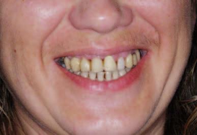 Opis przypadku _ Interdyscyplinarne leczenie estetyczne Rozwiązanie estetyczne przy wykorzystaniu pojedynczych koron na wszczepach i własnych zębach Aesthetic solution by using a single crowns on and