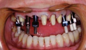 Opis przypadku _ Interdyscyplinarne leczenie estetyczne Ryc. 5 Ryc. 6 Ryc. 5_Zdj cie OPG po wszczepieniu implantów w szcz ce. Ryc. 6_Zdj cie OPG stan po wszczepieniu implantów w szcz ce i uchwie. Ryc. 7_Transfery przy wyciskach metodà otwartà pod tymczasowe uzupełnienia.