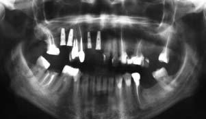 Po wszcze - pieniu implantów i założeniu na nie łączników penetrujących błonę śluzową, organizm reaguje odtworzeniem niezbędnej szerokości biologicznej pomiędzy środowiskiem jamy ustnej a kością.
