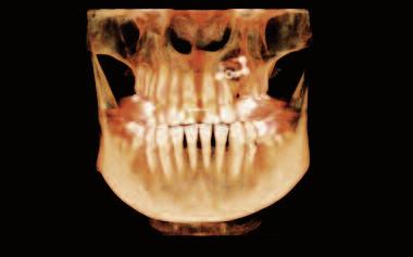 Spis treêci _ Wykorzystanie autologicznych preosteoblastów hodowanych in vitro_6 Ocena porównawcza stabilizacji pierwotnej implantów tytanowych i cyrkonowych_16 Prawo lekarza do odmowy udzielenia