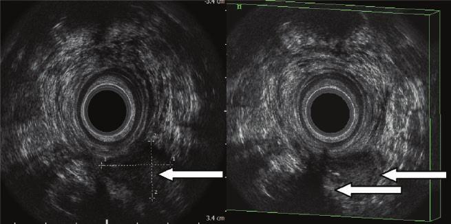 Ograniczenia i trudności ultrasonografii przezodbytniczej w diagnostyce przetok odbytu z przetoką.