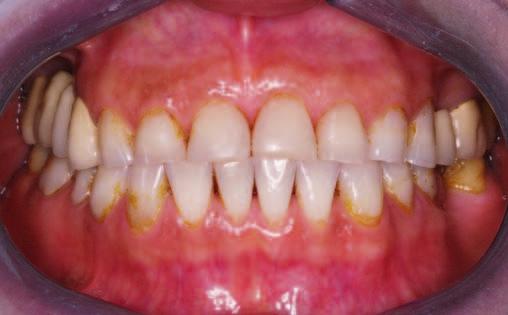 Zdjęcie wewnątrzustne przedstawiające widok zębów w pełnym zgryzie
