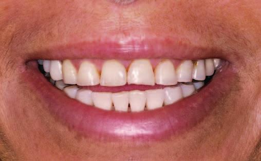 Analiza poziomu szyjek i długości koron klinicznych zębów w łuku górnym;