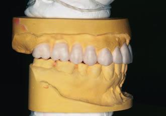 wcześniejszej analizie poziomu kości przy zębach przednich okazało się możliwe wykonanie elektromomii a nie gingiwektomii i w znieczuleniu