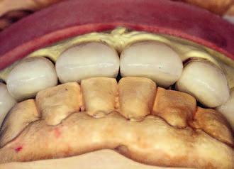 Zaraz po zakończeniu leczenia zębów w łuku górnym można było zająć się wykonaniem wspomnianych w planie leczenia nakładów porcelanowych na startych