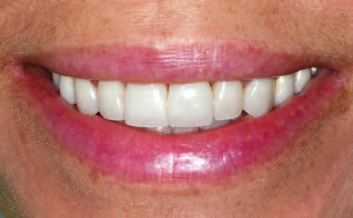 Refleksy świetlne powodują, iż zęby dzięki swej mikrostrukturze
