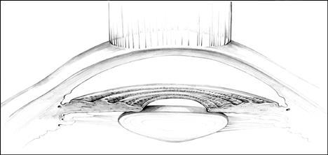 off and photoablation applied