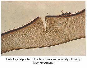 foto-ablacja w okulistyce, 3 Excimer laser