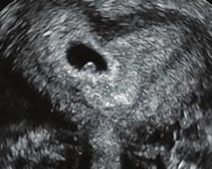 Dokładność datowania ultrasonograficznego w pierwszym trymestrze ciąży