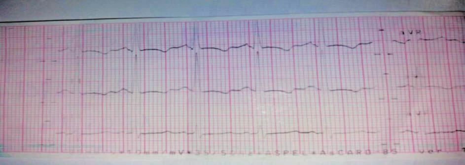 Zmiany w EKG o charakterze przerostu lewej komory z zaburzeniami repolaryzacji możliwe trudności diagnostyczne... Ryc. 1. Elektrokardiogram wykonany w gabinecie lekarza rodzinnego.