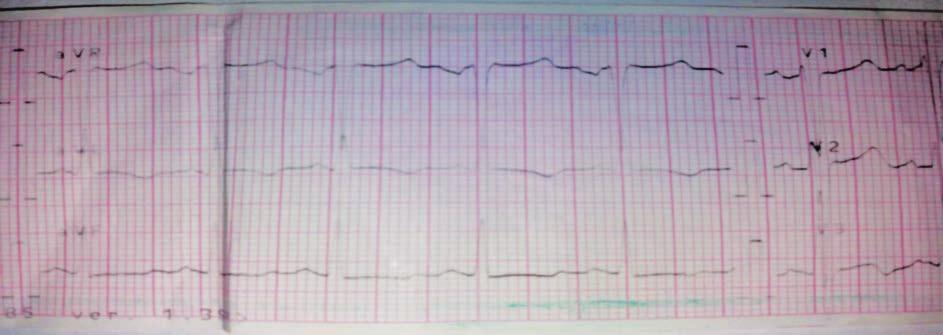 4. Elektrokardiogram wykonany w gabinecie lekarza rodzinnego. Odprowadzenia V4, V5, V6 Ryc. 5. Elektrokardiogram wykonany w izbie przyjęć. Odprowadzania kończynowe Ryc. 6.