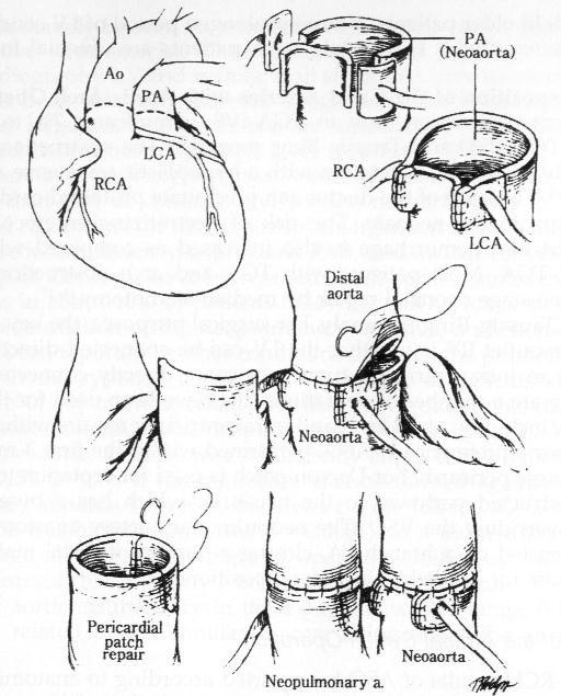 TGA operacja Jaten a Arterial Switch połączenie aorty z pniem płucnym, połączenie pnia