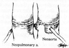 TGA Korekcja anatomiczna (ASO-arterial switch-jatene) Wyniki