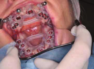 _opis przypadku posiadanych protez oraz zdjęć twarzy, zaproponowano pacjentce wykonanie zabiegu implantologicznego w szczęce implantami MIS Seven z użyciem szablonu chirurgicznego w technice MGuide,