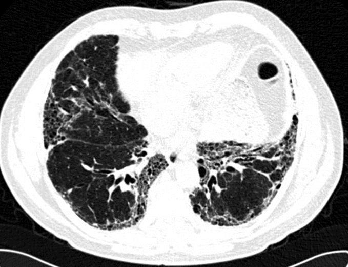 Pirfenidon - praktyka codzienna 63 letni mężczyzna, były palacz papierosów (60 paczkolat) IPF rozpoznane w 2015 roku na podstawie obrazu kliniczno radiologicznego Bez chorób współistniejących Nie