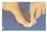Leczenie należy kontynuować do czasu pojawienia się w pełni zdrowej płytki paznokciowej, co następuje po około 6 miesiącach w przypadku paznokci dłoni i od 9 do 12 miesięcy w przypadku paznokci stóp.