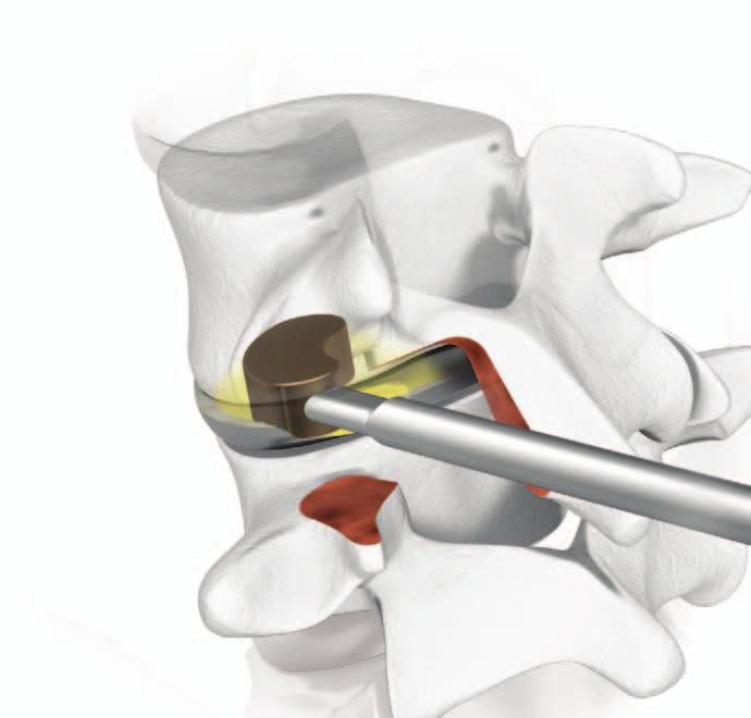 IV.7. Dobór rozmiaru implantu Rozmiar implantu (wysokość, szerokość) dobiera się