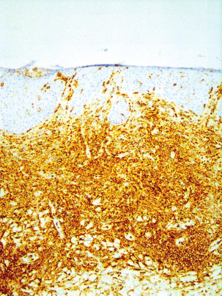 Skórny chłoniak wielkokomórkowy Rycina 5. Ekspresja antygenu CLA na komórkach nowotworowych (barwienie immunohistochemiczne) Rycina 6.
