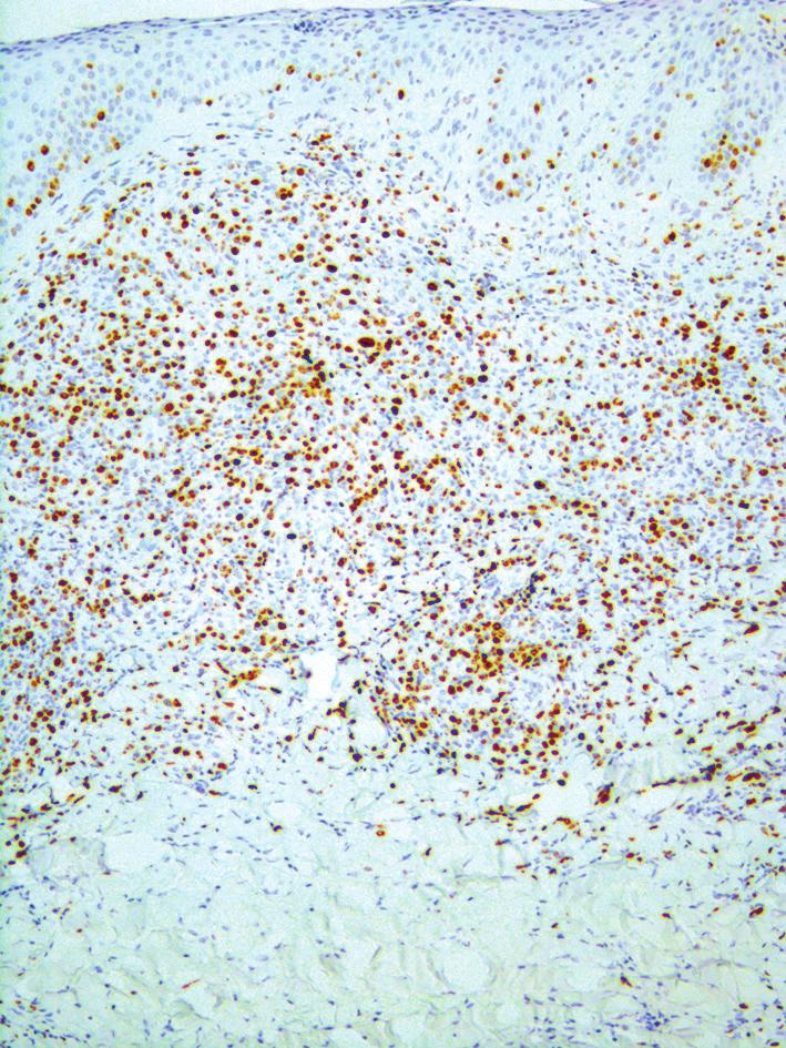 Expression of CLA antigen on the neoplastic cells (IHC) Figure 6. Ki-67 index (+) in 30 40% of cells (IHC) A B Rycina 7. A, B.