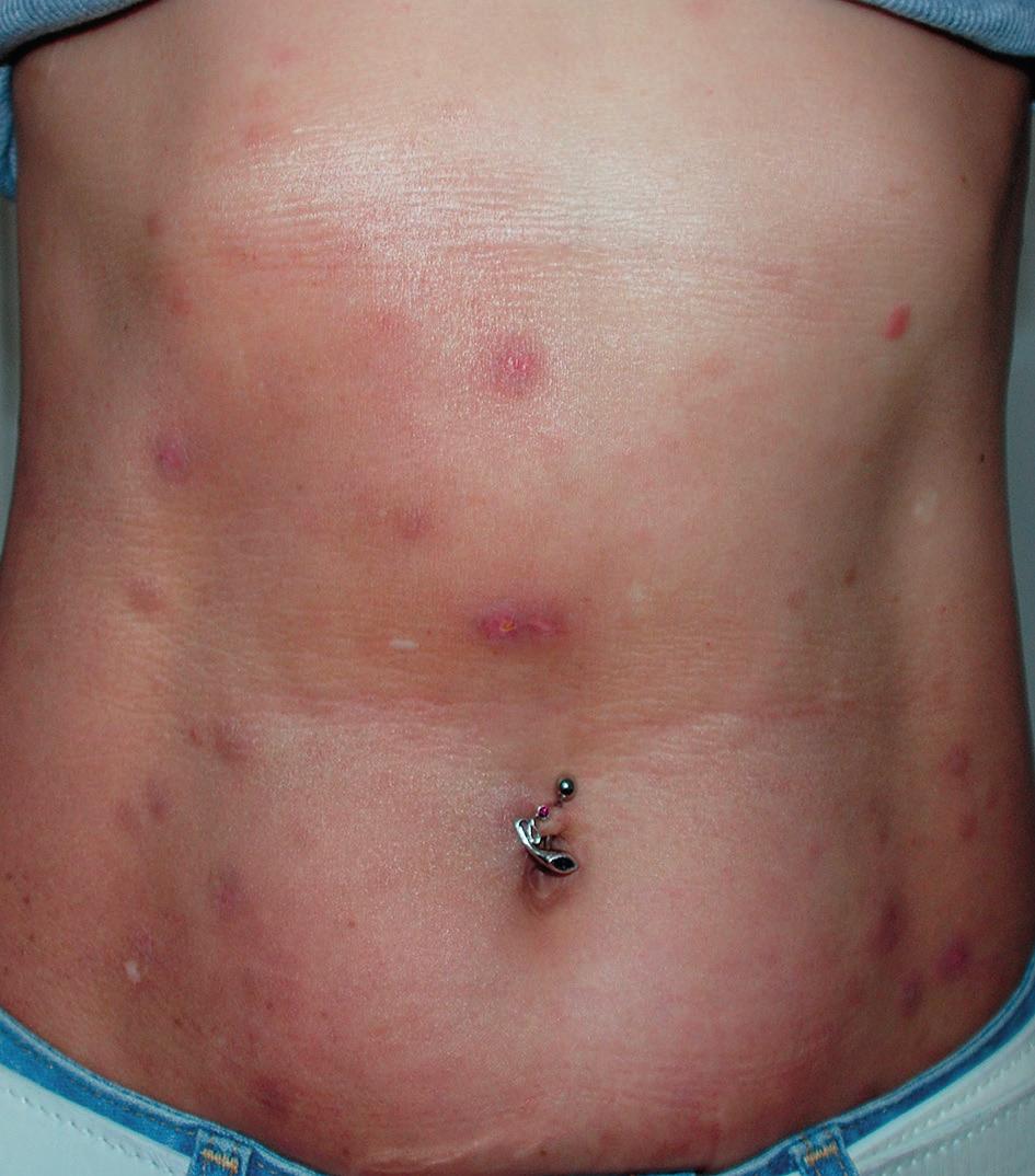 Regression of the skin lesions 2 weeks after hospitalization leczenia, o zachowaniu postawy wyczekującej do czasu otrzymania wyników badania