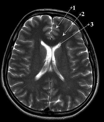 W kolejnym przykładzie zanalizujemy obraz MRI głowy. Budowa anatomiczna pokazana jest na rysunku z zaznaczonymi głównymi strukturami: istota białą, szarą oraz płynem mózgowo-rdzeniowym. Rys.5.3.