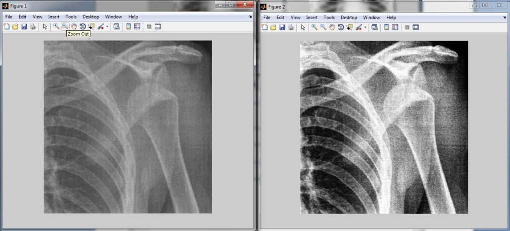 W następnym skrypcie realizujemy przetwarzanie obrazu filtrami medianowym, minimalnym i maksymalnym. %filtr medianowy B1= imread('d:\\med_image\\zlamanie_barku.