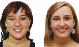 a) b) c) d) Chirurgicznie wspomagane rozerwanie szwu podniebiennego SARME (Surgicall Assisted Rapid Maxillary Expansion) jest zabiegiem dedykowanym wszelkim kostnym poprzecznym niedorozwojom szczęki.