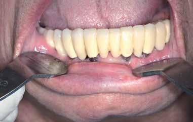 Powikłania _ Periimplantitis _Wnioski Zapalenie tkanek wokół implantów ( periimplantitis) stanowi poważny problem współczesnej implantologii, w którym najważniejszym czynnikiem etiologicznym jest