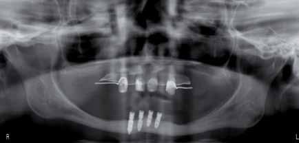 Także i ten implant został stworzony w oparciu o nowoczesne metody obrazowania i model stereolitograficzny.