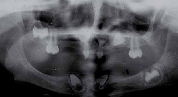 Zaburzenia rozwojowe _ Implantoprotetyka Problemy leczenia ortodontycznego i implantoprotetycznego u pacjentów z dysplazją ektodermalną Problems of orthodontic and implant prosthetic treatment