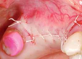 _autor Dr n. med. Jarosław Pospiech specjalista chirurgii stomatologicznej, koordynator grupy badawczej infini-ti.com Kontakt: Specjalistyczna Praktyka Stomatologiczna implantpoint Tel.