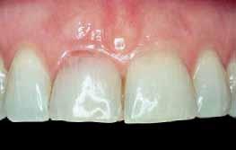 Praktyka _ Tkanki wokół implantu Ryc. 1_Przypadek 1. Początkowy stan kliniczny z luźnymi siekaczami środkowymi i krwawieniem wewnętrznym. Ryc. 2_Natychmiastowe wszczepienie sąsiadujących implantów z przednim płatem na przeszczepie tkanki łącznej i z koroną tymczasową.