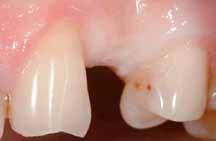 Praktyka _ Tkanki wokół implantu cie zmniejsza nacisk na implant, odsuwając go od kołnierza i umożliwia lepszy rozkład sił wzdłuż całego implantu, co pośrednio zmniejsza resorpcję kości szyjkowej.