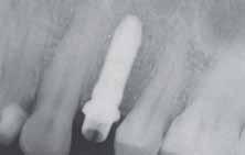Po kilku miesiącach implant wszczepiany jest z filarem gojącym lub bez o wysokości podobnej do szczytów sąsiadujących brodawek międzyzębowych w celu uzyskania bazy w postaci grubej tkanki łącznej.
