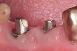 Implantoprotetyka _ Korony, mosty, łączniki Łączniki indywidualne w odcinku bocznym Individual abutments in lateral teeth Autorzy_ SvenRinke i Paul Görlach Streszczenie: Implanty stomatologiczne od