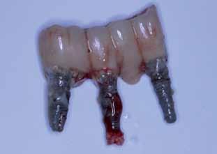Powikłania _ Periimplantitis Ryc. 3 Ryc. 4 tkanek wokół implantu.