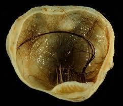 łac. teratoma, z gr.