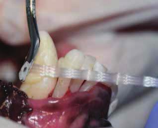 6 Szynowanie periodontologiczne Szynowanie periodontologiczne jest alternatywą dla unieruchomienia zębów. Wskazane jest w przypadku rozchwiania zębów siecznych szczęki lub żuchwy.