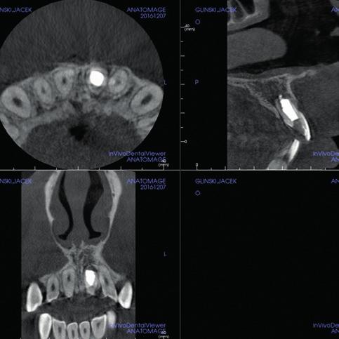 CBCT sprzed leczenia, widoczne rozległe rozrzedzenie struktury