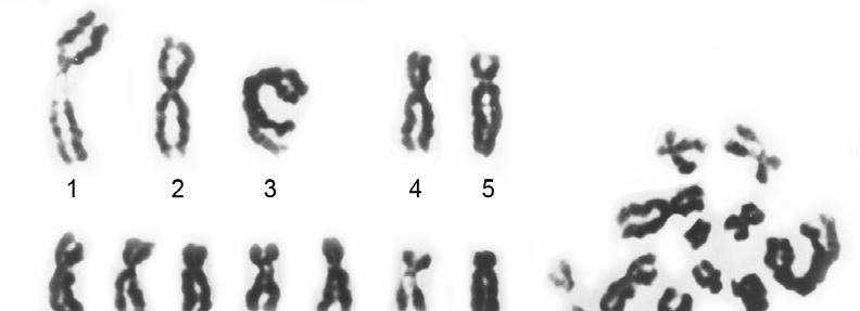50 A. B. C. Ryc. 8. Przykłady aberracji chromosomów plemnikowych wymienione w tabeli 15. A. Kariotyp (oraz płytka metafazowa) plemnika 24,XY (plemniki od Nr 39); B. Kariotyp plemnika 24,XY,-11,+i(11?