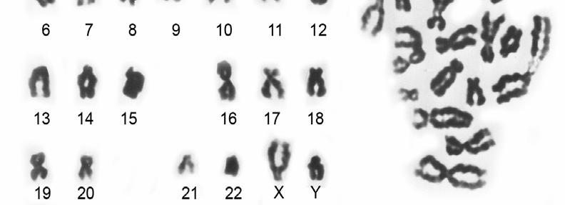 Example of aberrations of sperm chromosomes listed in table 15. A. Karyotype and sperm chromosome complements in case 24,XY (spermatozoa from No. 39). B. Karyotype of spermatozoon 24,XY,-11,+(11?